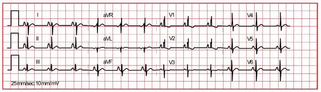 ECG-ASD.jpg